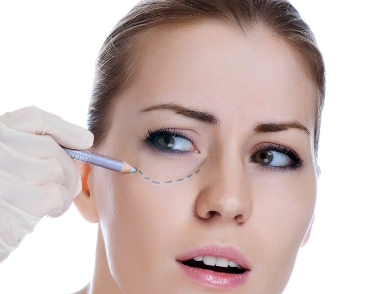 Eyelift-non-surgical