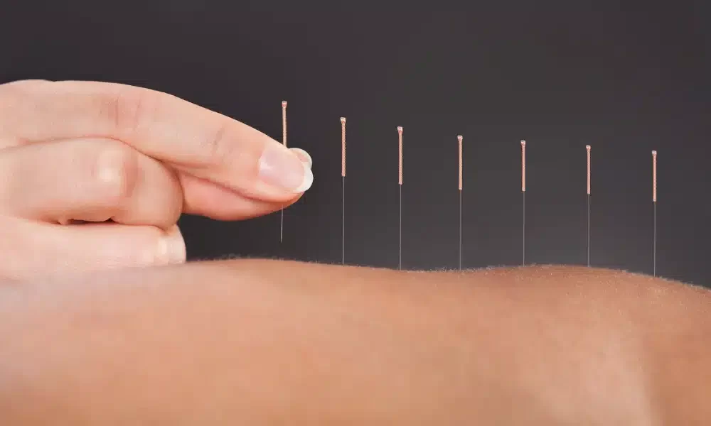 What_Is_Acupuncture