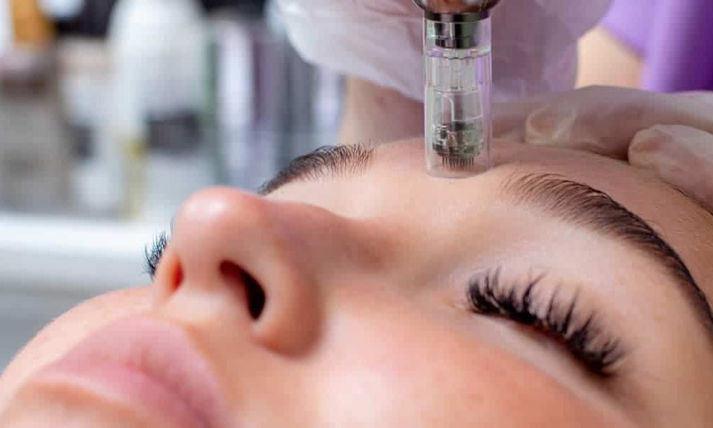 microneedling-treatment