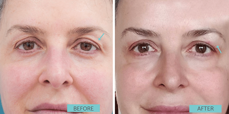 non-surgical-eyelift-benefits